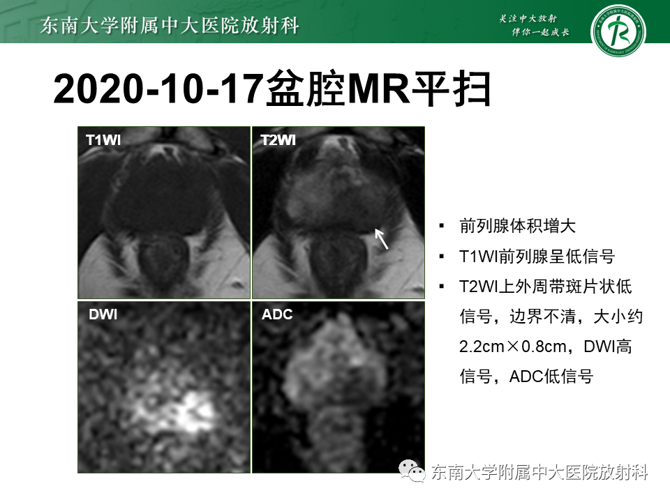 【PPT】前列腺癌-18
