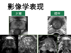 前列腺癌