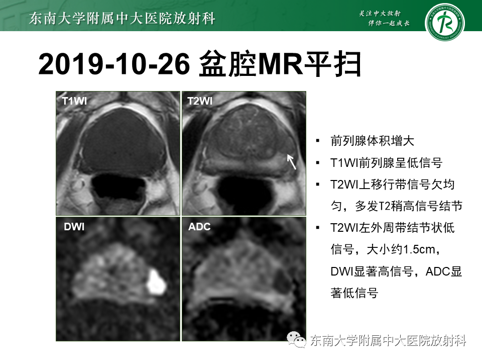 【PPT】前列腺癌-4