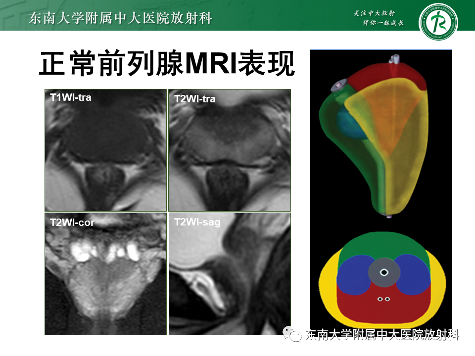 【PPT】前列腺癌-11
