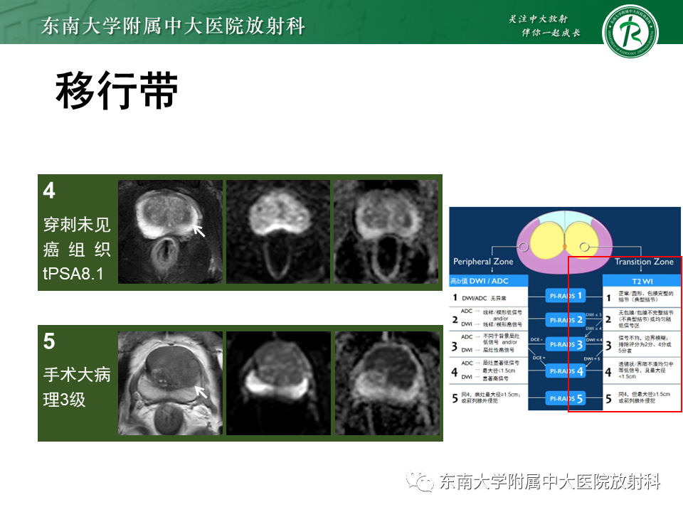 【PPT】前列腺癌-22