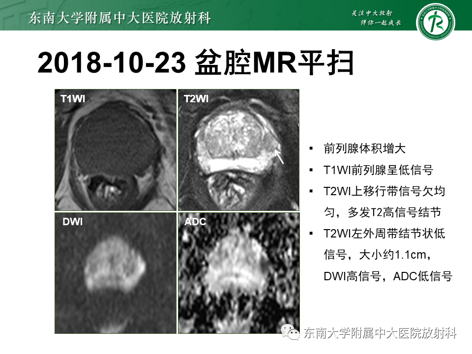 【PPT】前列腺癌-3