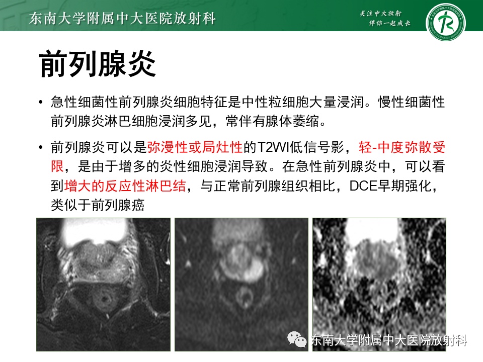 【PPT】前列腺癌-26