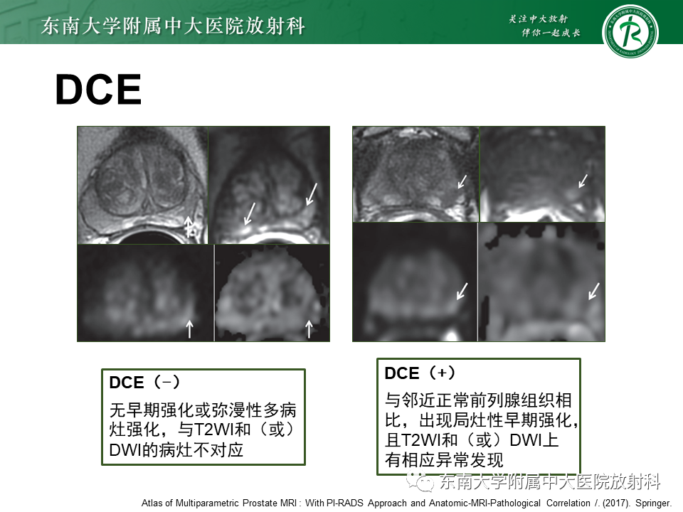 【PPT】前列腺癌-23