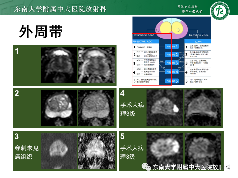【PPT】前列腺癌-16