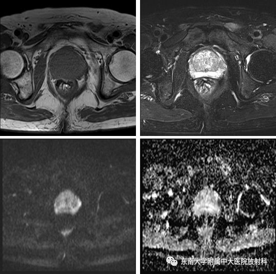 【PPT】前列腺癌-1