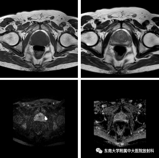 【PPT】前列腺癌-2