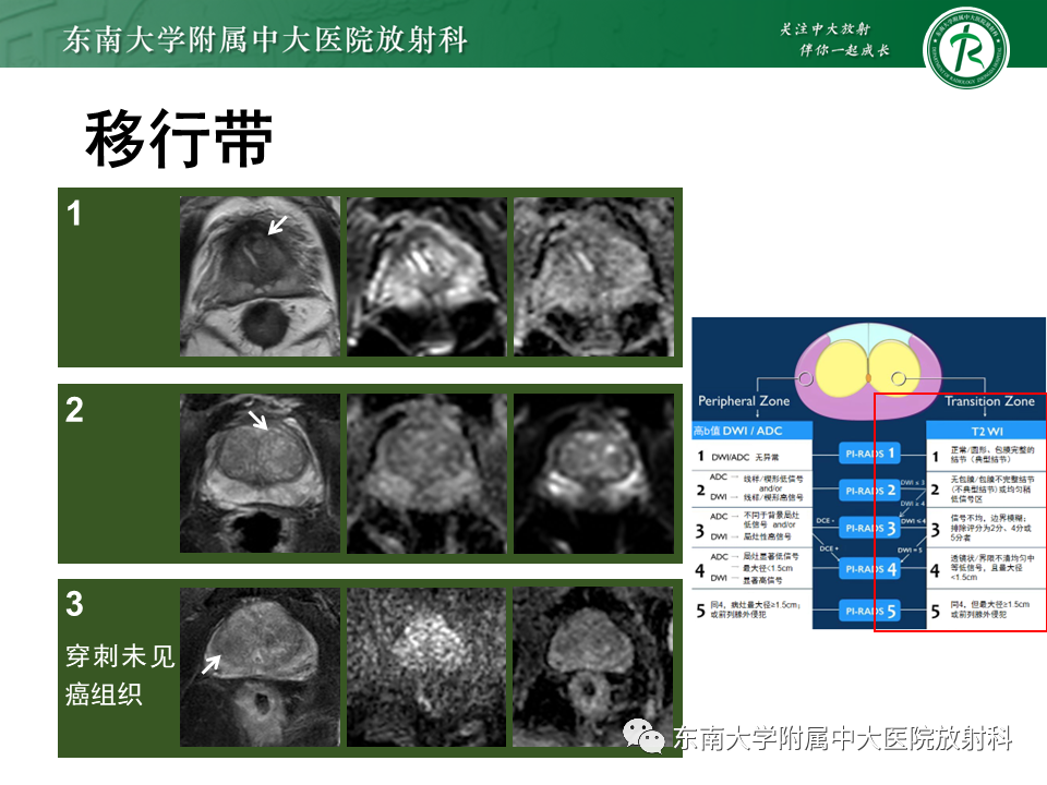 【PPT】前列腺癌-21