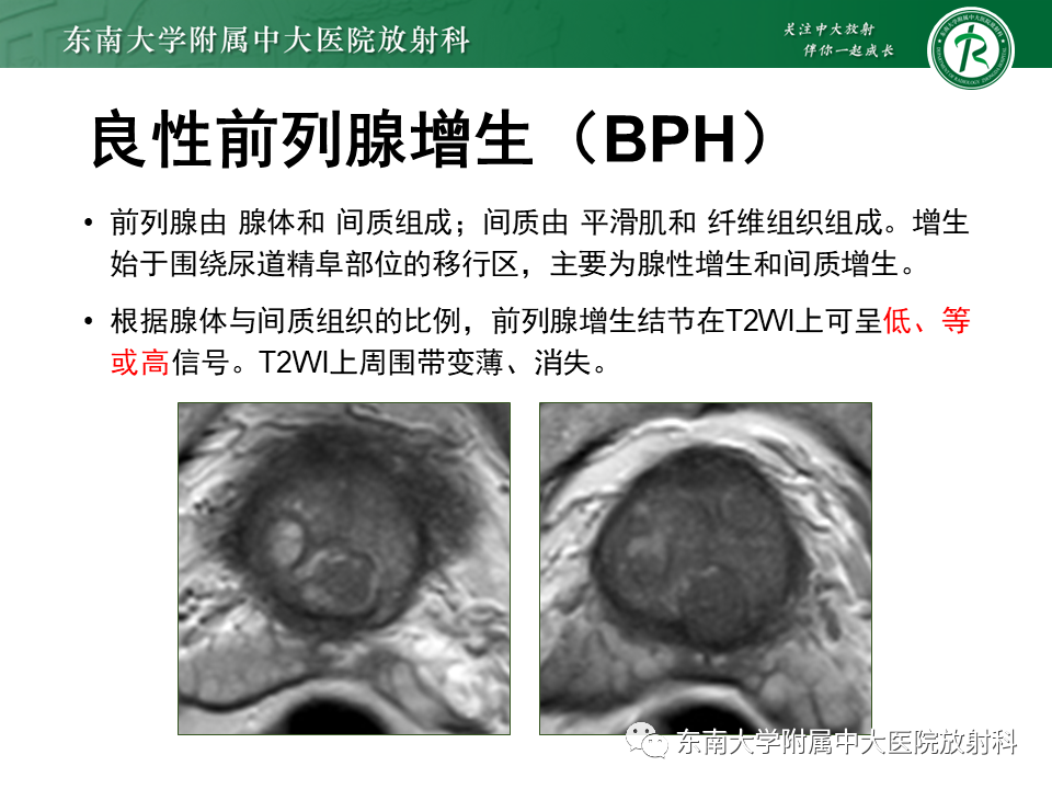 【PPT】前列腺癌-25