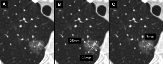 肺结节大小测量的推荐意见-4 肺结节大小测量的推荐意见-4