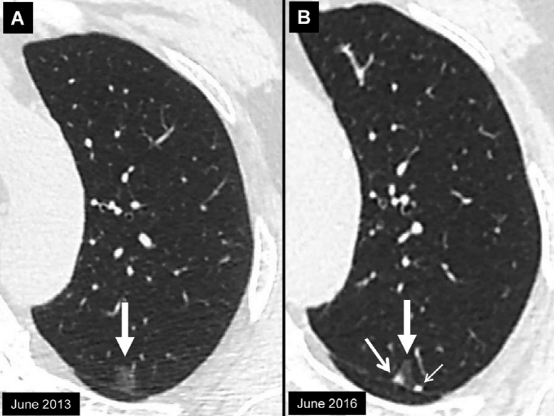 肺结节大小测量的推荐意见-17 肺结节大小测量的推荐意见-17