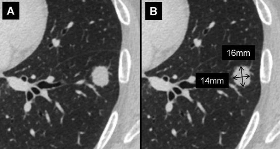 肺结节大小测量的推荐意见-2 肺结节大小测量的推荐意见-2