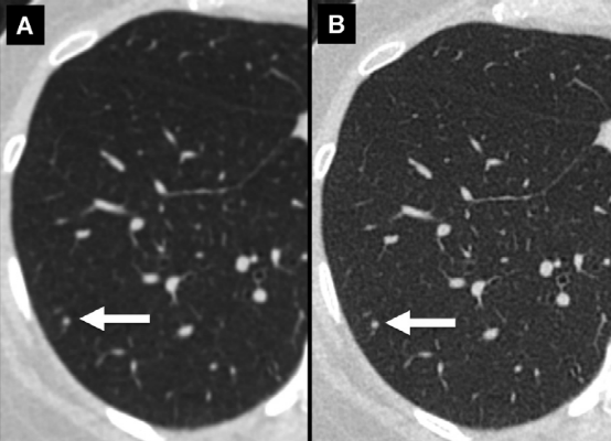 肺结节大小测量的推荐意见-8 肺结节大小测量的推荐意见-8