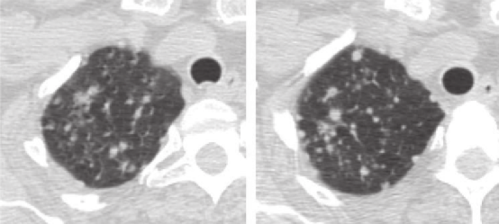 肺结节大小测量的推荐意见-11 肺结节大小测量的推荐意见-11