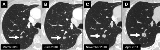 肺结节大小测量的推荐意见-13 肺结节大小测量的推荐意见-13