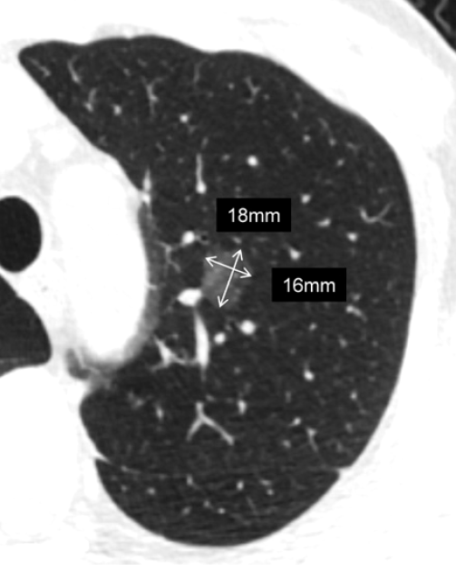肺结节大小测量的推荐意见-3 肺结节大小测量的推荐意见-3