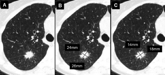 肺结节大小测量的推荐意见-15 肺结节大小测量的推荐意见-15