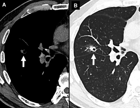 肺结节大小测量的推荐意见-9 肺结节大小测量的推荐意见-9