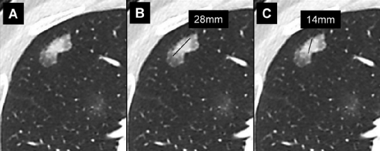 肺结节大小测量的推荐意见-18 肺结节大小测量的推荐意见-18
