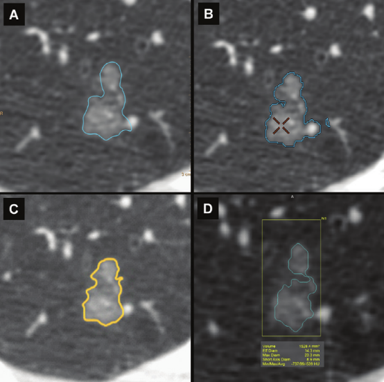 肺结节大小测量的推荐意见-19 肺结节大小测量的推荐意见-19