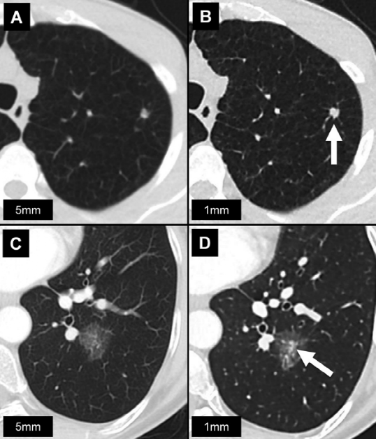 肺结节大小测量的推荐意见-6 肺结节大小测量的推荐意见-6