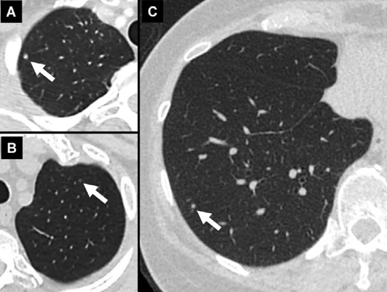 肺结节大小测量的推荐意见-5 肺结节大小测量的推荐意见-5