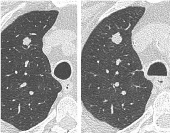 肺结节大小测量的推荐意见-12 肺结节大小测量的推荐意见-12