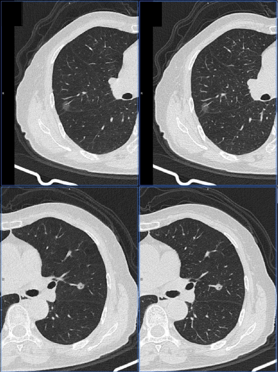 肺结节大小测量的推荐意见-10 肺结节大小测量的推荐意见-10