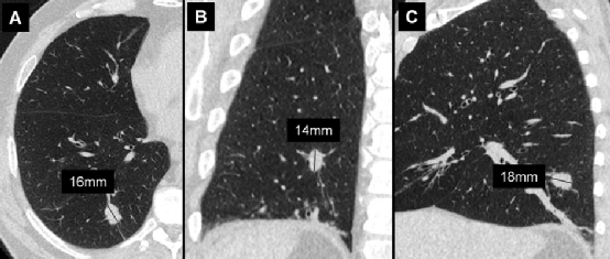 肺结节大小测量的推荐意见-7 肺结节大小测量的推荐意见-7