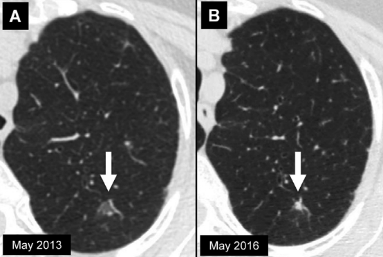 肺结节大小测量的推荐意见-16 肺结节大小测量的推荐意见-16