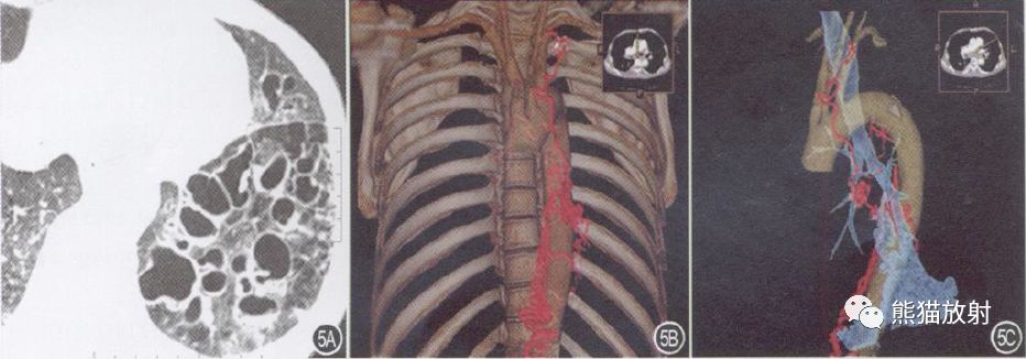 支气管动脉CTA-10 支气管动脉CTA-10