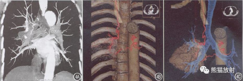 支气管动脉CTA-9 支气管动脉CTA-9