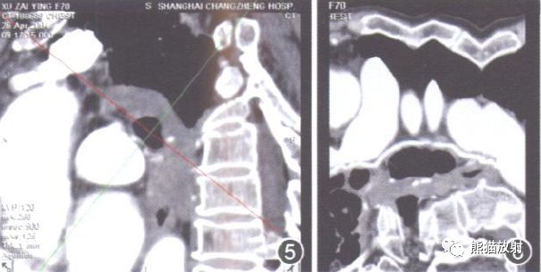 支气管动脉CTA-3 支气管动脉CTA-3