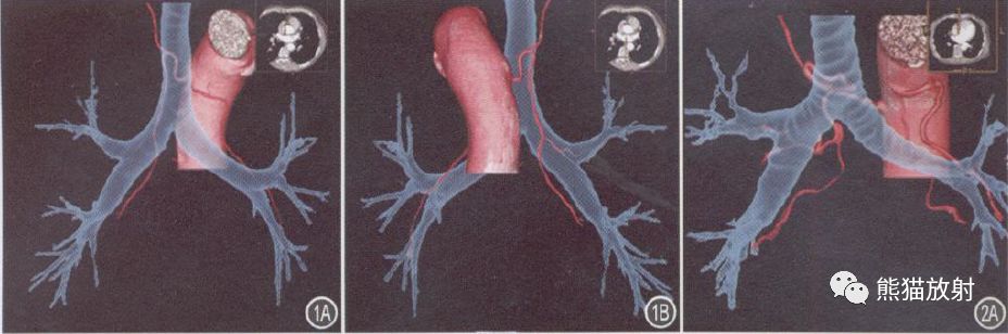支气管动脉CTA-7 支气管动脉CTA-7