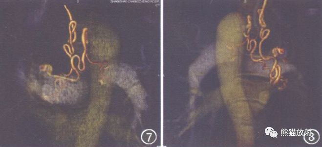 支气管动脉CTA-4 支气管动脉CTA-4