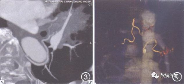 支气管动脉CTA-2 支气管动脉CTA-2