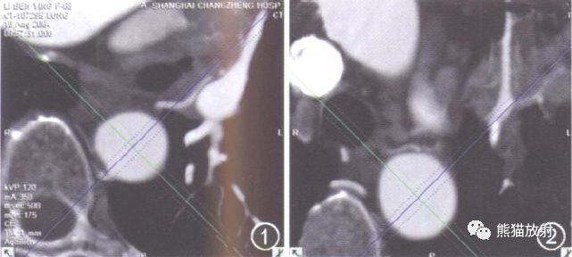 支气管动脉CTA-1 支气管动脉CTA-1