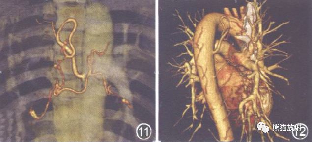 支气管动脉CTA-6 支气管动脉CTA-6
