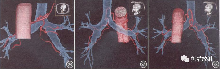 支气管动脉CTA-8 支气管动脉CTA-8