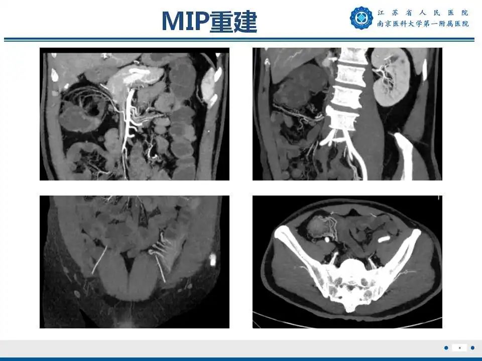 【PPT】克罗恩病-7