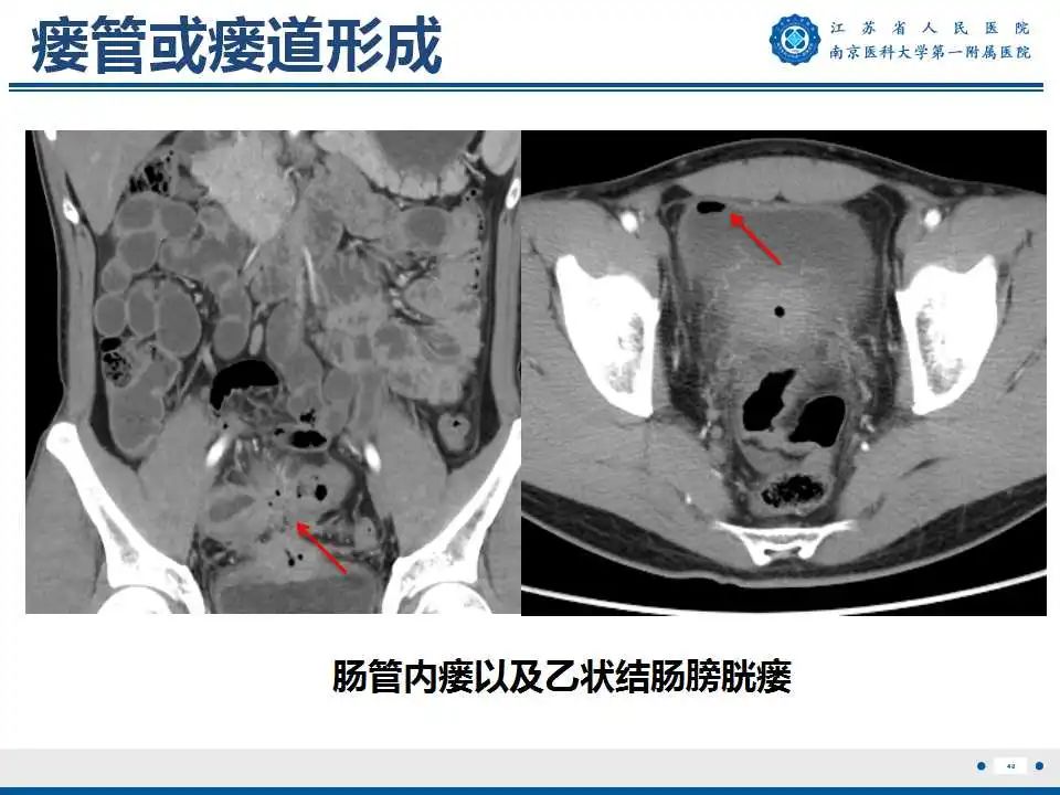 【PPT】克罗恩病-41