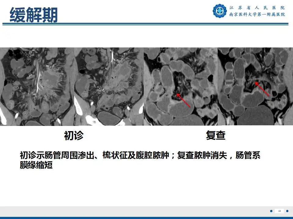 【PPT】克罗恩病-36
