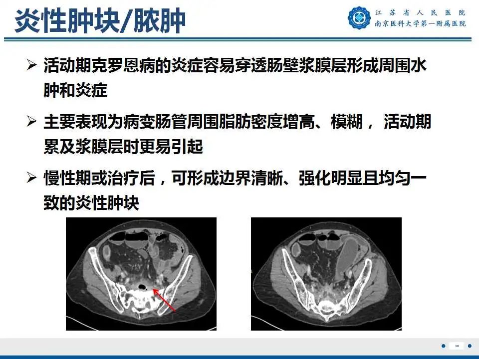 【PPT】克罗恩病-39