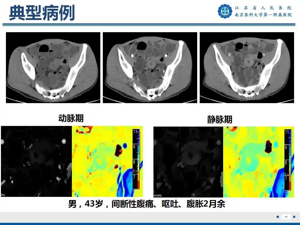 【PPT】克罗恩病-50