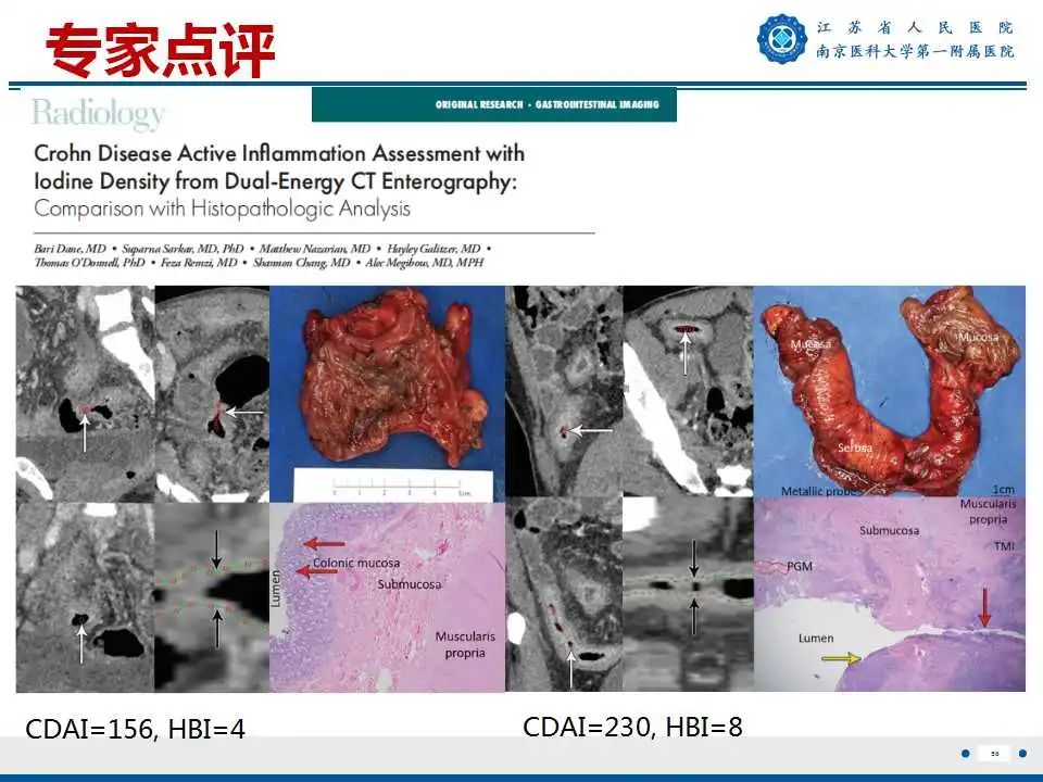 【PPT】克罗恩病-57