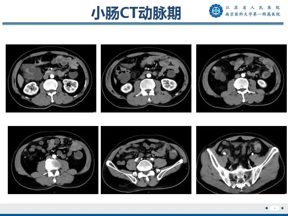 【PPT】克罗恩病-4