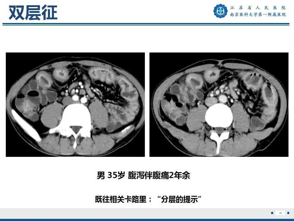 【PPT】克罗恩病-31