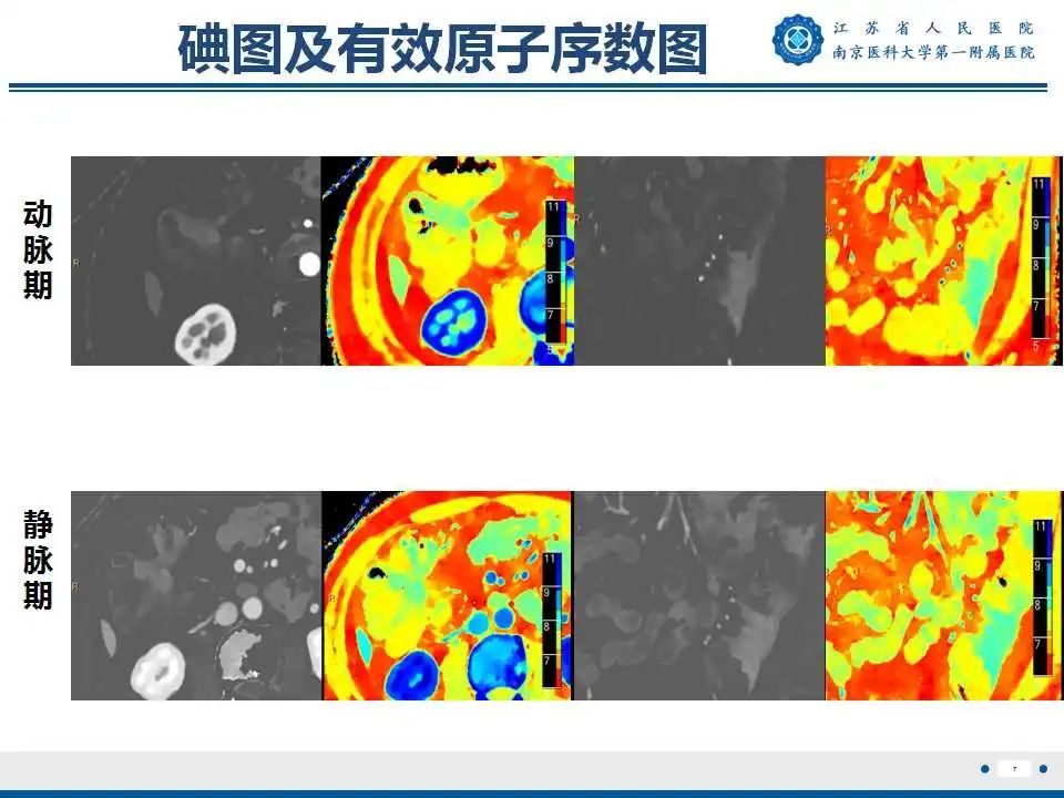【PPT】克罗恩病-8