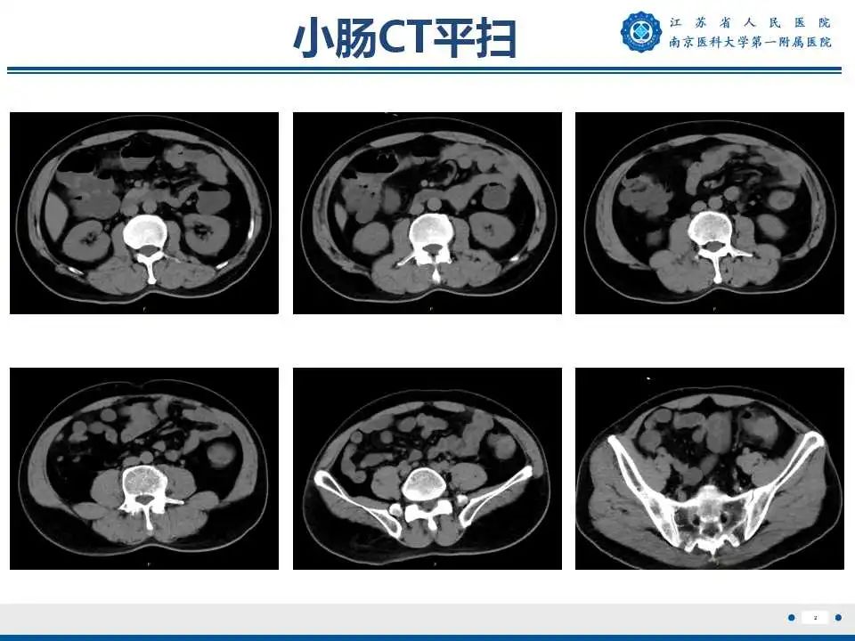 【PPT】克罗恩病-3