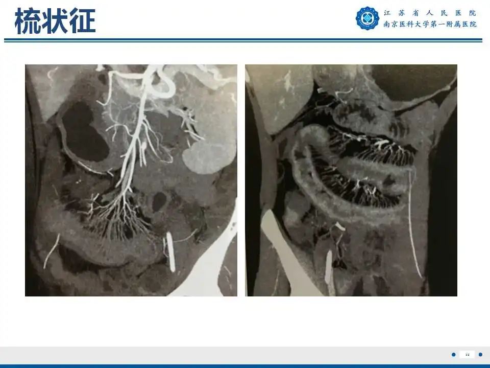 【PPT】克罗恩病-33